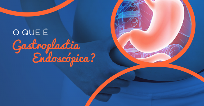 O que é gastroplastia endoscópica - Clínica EDT - Balão Gástrico