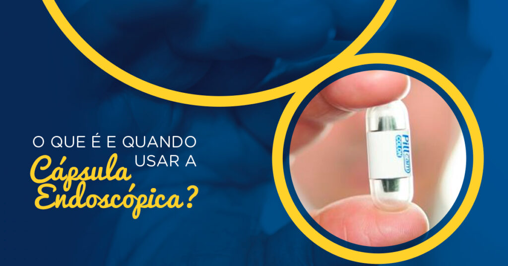 O que é e quando usar a Cápsula endoscópica?